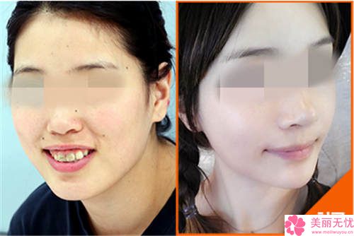 整容要花多少錢就整一張臉？深度解析全臉整形費用構(gòu)成與預算攻略